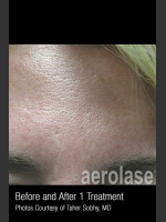 Before Photo Treatment of Pores and Skin Texture #338 - Prejuvenation Before & After
