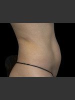 Before Photo Body Contouring Treatment #118 - Prejuvenation Before & After