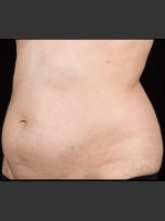 Before Photo SculpSure Abdomen - Prejuvenation Before & After
