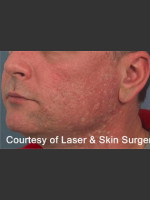 Before Photo Treatment of Facial  Acne Scars - Prejuvenation Before & After