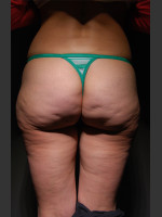 Before Photo Cellfina Case #2 - Prejuvenation Before & After