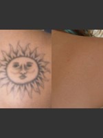 After Photo Tattoo Removal - Prejuvenation Before & After