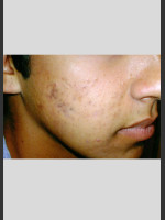 After Photo elos Technology AC for Acne Treatment - Prejuvenation Before & After