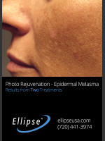 Before Photo Treatment of Pigmentation and Melasma  - Prejuvenation Before & After