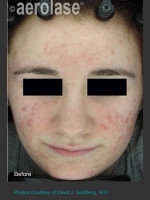 Before Photo NeoClear by Aerolase Acne Treatment - Prejuvenation Before & After