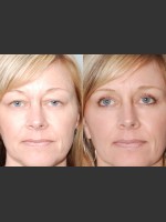 After Photo Two women with Laser Eyelid Blepharoplasty - Prejuvenation Before & After