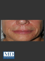 After Photo Nasolabial Fold and Lip Filler 137 - Prejuvenation Before & After