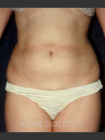 Before Photo Liposuction 439 - Prejuvenation Before & After