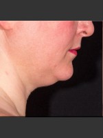 Before Photo SculpSure Submental - Prejuvenation Before & After