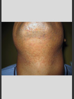 After Photo Gentle Laser Hair Removal of Beard Bumps - Prejuvenation Before & After