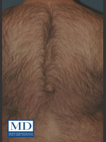 Before Photo Laser Hair Removal 122 - Prejuvenation Before & After