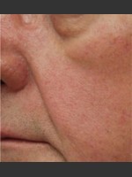 After Photo Dr. Langdon IPL Treatment  - Prejuvenation Before & After