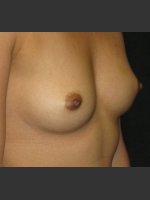 Before Photo Breast Augmentation - Prejuvenation Before & After
