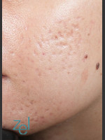 Before Photo Fractional Resurfacing Acne Scars - Prejuvenation Before & After