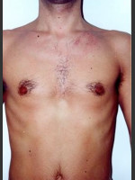 Before Photo Quanta Light Series Laser Hair Removal #74 - Prejuvenation Before & After