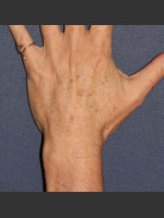 Before Photo Sun Spot Removal on Hands - Prejuvenation Before & After