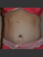 After Photo Dr. Palmer Tummy Tuck 02 - Prejuvenation Before & After
