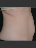 Before Photo SculpSure Abdomen - Prejuvenation Before & After