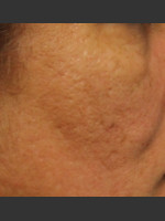 After Photo Infini Acne Scar Treatment #12 - Prejuvenation Before & After