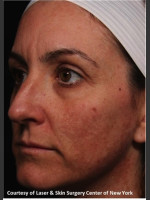Before Photo Facial Skin Rejuvenation with Clear and Brillant Permea - Prejuvenation Before & After