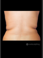Before Photo CoolSculpting Before & After on Woman - Prejuvenation Before & After