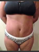 After Photo Dr. Palmer Tummy Tuck 01  - Prejuvenation Before & After