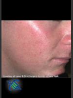 After Photo Treatment of Facial  Acne Scars - Prejuvenation Before & After
