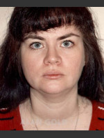 Before Photo Liposuction of Neck 96 - Prejuvenation Before & After