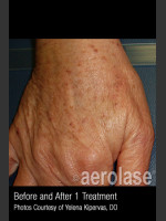 Before Photo Treatment of Pigmentation #329 - Prejuvenation Before & After