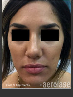 After Photo NeoClear by Aerolase Acne Treatment - Prejuvenation Before & After
