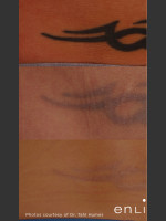 Before Photo Tattoo Removal on Lower Back - Prejuvenation Before & After