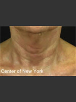 After Photo Treatment of Fine lines and Wrinkles - Prejuvenation Before & After