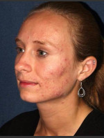 Before Photo Facial Acne Treatment - Prejuvenation Before & After