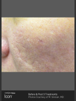 After Photo Acne Scaring on the Cheeks - Prejuvenation Before & After