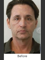 Before Photo Sculptra Rejuvenation for Man - Prejuvenation Before & After