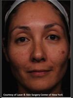 Before Photo Treatment of Melasma - Prejuvenation Before & After