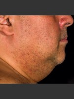 Before Photo SculpSure Submental - Prejuvenation Before & After