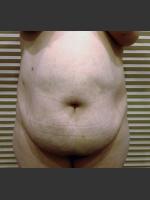 Before Photo Dr. Palmer Tummy Tuck 02 - Prejuvenation Before & After