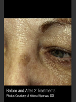 Before Photo Treatment of Facial Pigmentation #330 - Prejuvenation Before & After