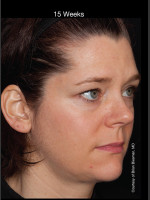 After Photo Hyperpigmentation - Professional Peel - Prejuvenation Before & After