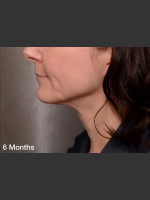 After Photo ThermiTight Treatment - Prejuvenation Before & After