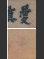 After Photo Laser Treatment of Tattoo - Prejuvenation Before & After