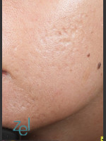After Photo Fractional Resurfacing Acne Scars - Prejuvenation Before & After