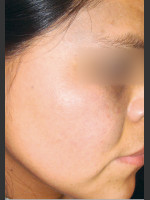 After Photo Quanta MDK Nevus of Ota Treatment #76 - Prejuvenation Before & After