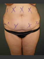 Before Photo Liposuction #44 Front View - Prejuvenation Before & After