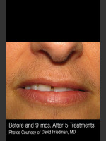 Before Photo Hair Removal #312 - Prejuvenation Before & After