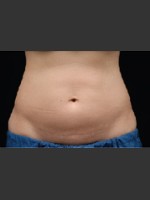 Before Photo Dr. Langdon CoolSculpting - Prejuvenation Before & After