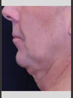 Before Photo Profound Contour Treatment of Neck - Prejuvenation Before & After