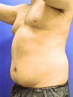 Before Photo Liposuction Case #1 - Prejuvenation Before & After