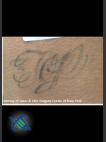 Before Photo Treatment of Lower Back Tattoo - Prejuvenation Before & After